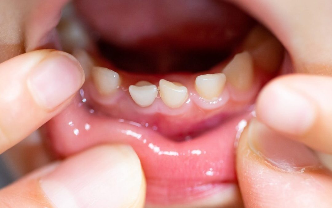 Denti da latte che non cadono: quando bisogna preoccuparsi?